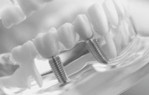 Lee más sobre el artículo Implantes dentales en Santander