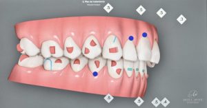 Lee más sobre el artículo Clincheck de Invisalign – Un vistazo al futuro de tu sonrisa